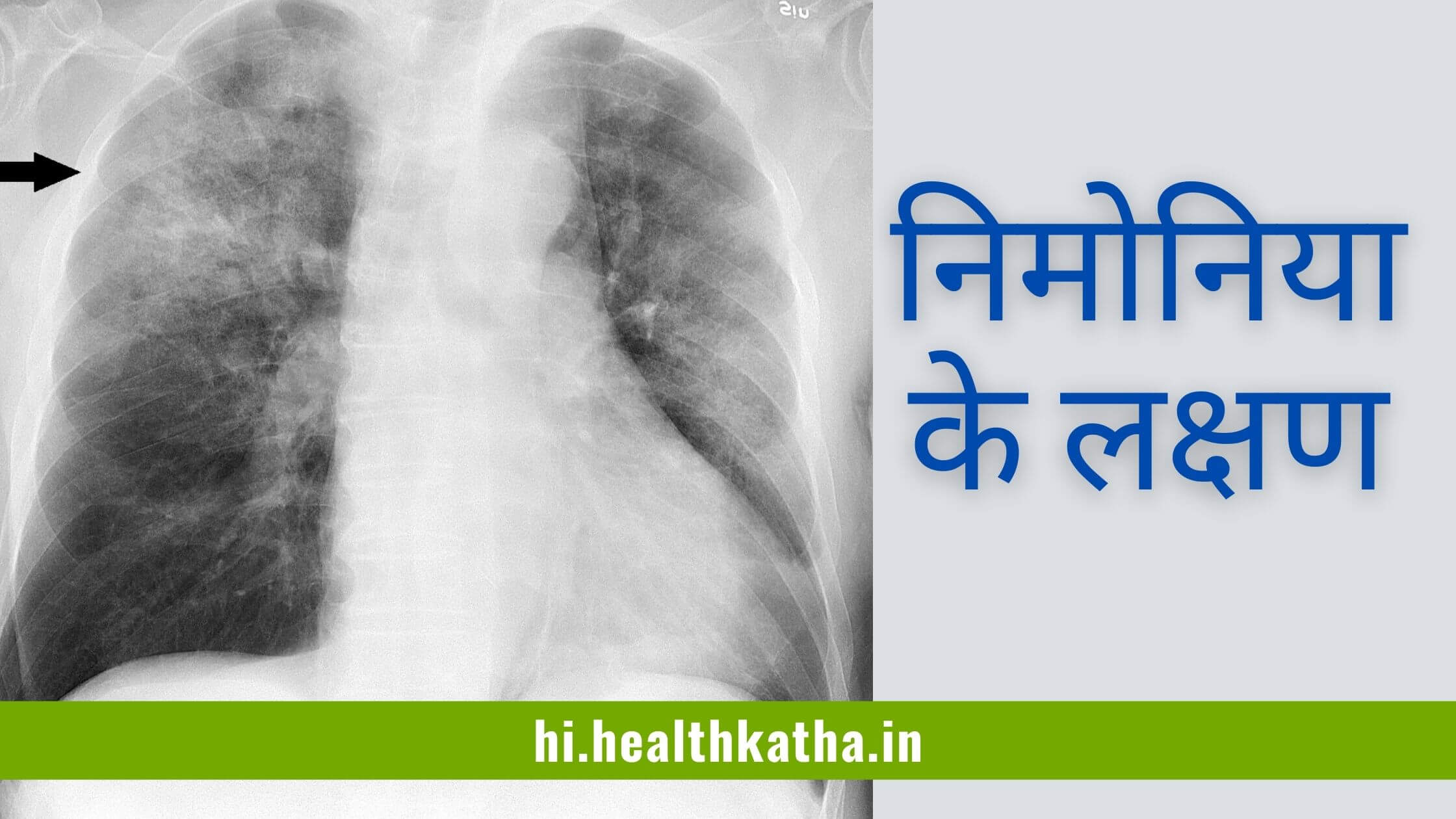 निमोनिया के लक्षण